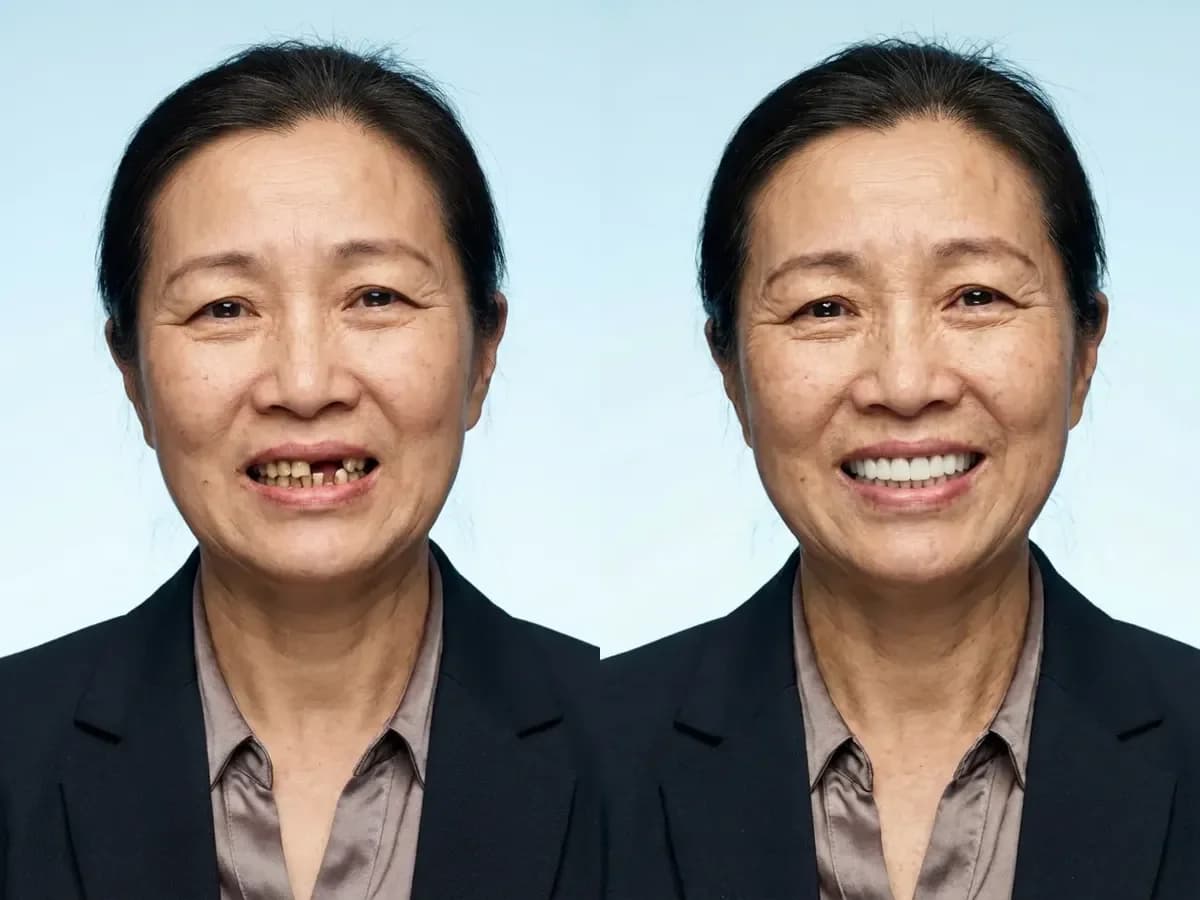 full mouth dental implants before and after case 3